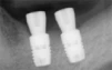 OsseoSpeed S (3.5,4.0) - 4